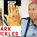 Dark Knuckle Whitening Serum In Westlake City in Ohio, United States Call +27710732372